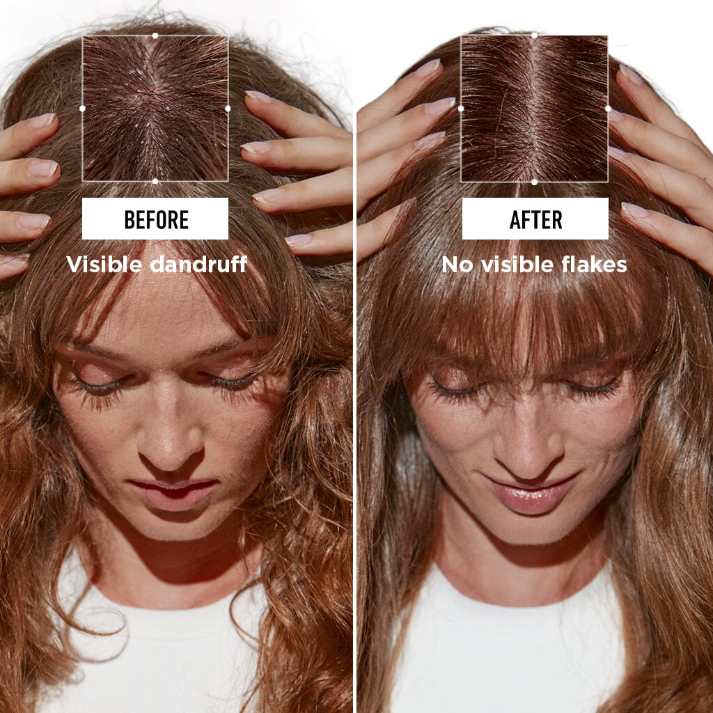 Kérastase Symbiose Anti Dandruff Spring Gift Set Before and After - HairMNL